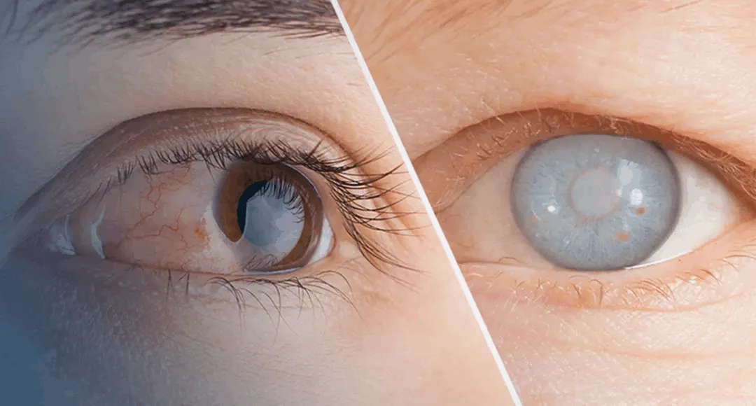 Cataract