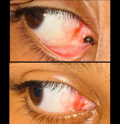 Caruncle Nevus