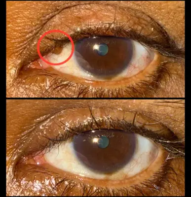 Eyelid margin Nevus