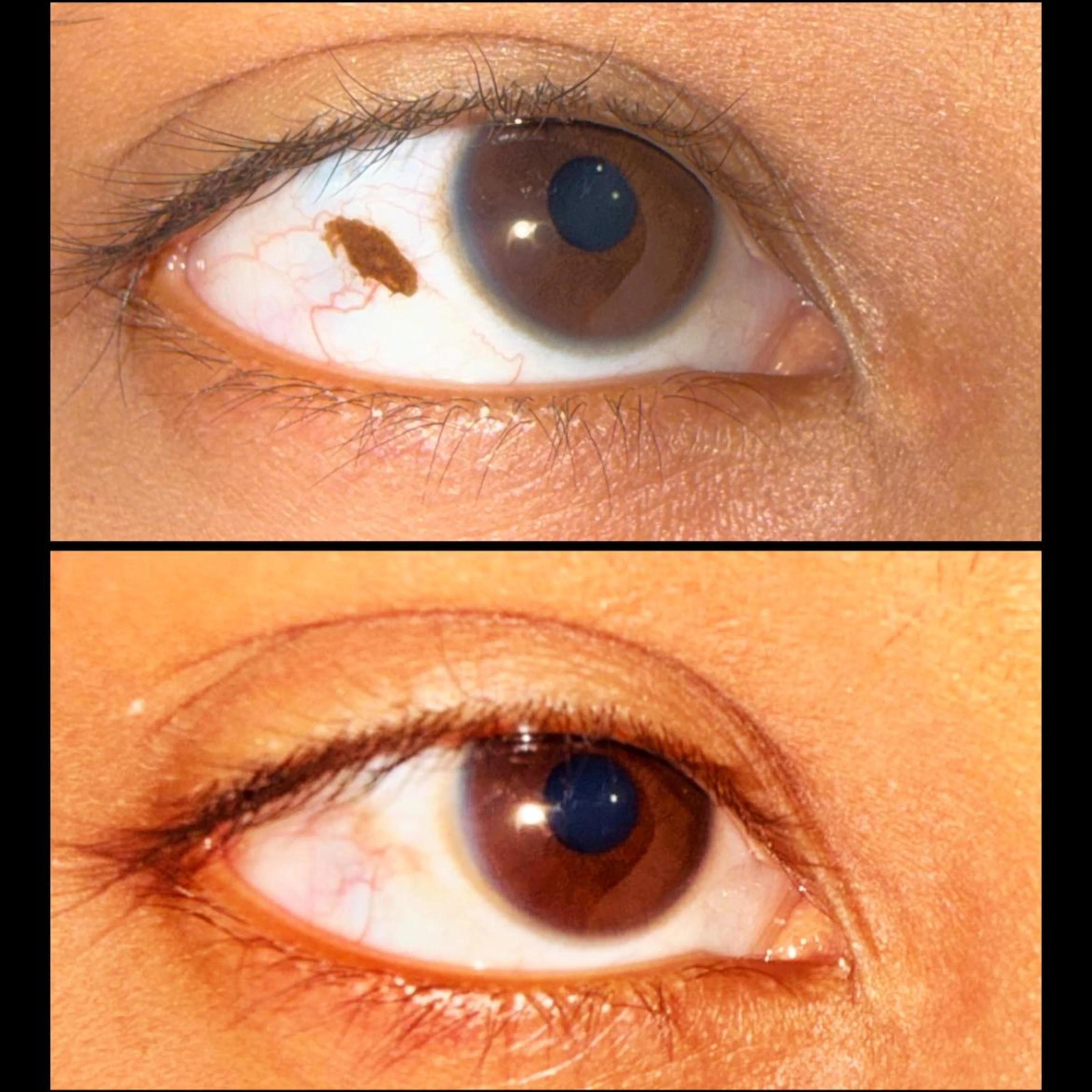 Conjunctival nevus